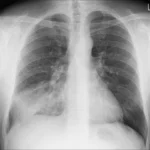 Pemerintah Laporkan 6 Kasus Mycoplasma Pneumoniae di Jakarta