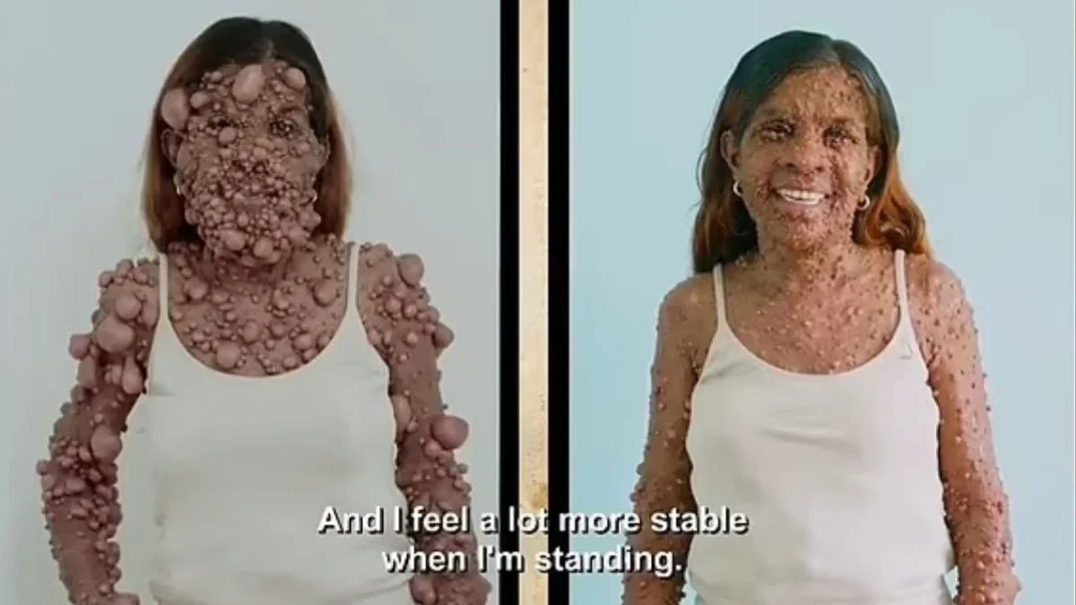 Seorang wanita di Trinidad bernama Charmaine Sahadeo memiliki ribuan tumor di sekujur tubuh, bahkan sampai men
